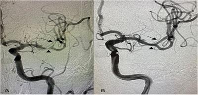 Initial Experience With the Next-Generation Resolute Onyx Zotarolimus-Eluting Stent in Symptomatic Intracranial Atherosclerotic Disease